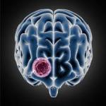 Indicators of Brain Tumors we usually overlook
								